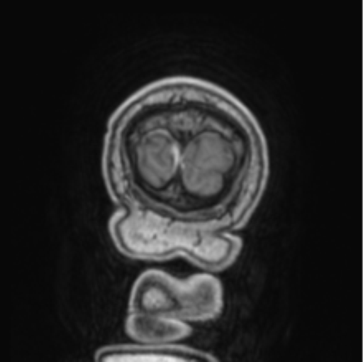 Cerebellar metastasis from lung adenocarcinoma (Radiopaedia 86690-102829 Coronal T1 C+ 4).png