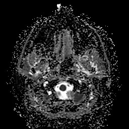 File:Cerebellar metastasis of pulmonary adenocarcinoma, cavernous venous malformation, and developmental venous anomaly (Radiopaedia 85827-101661 Axial ADC 4).jpg