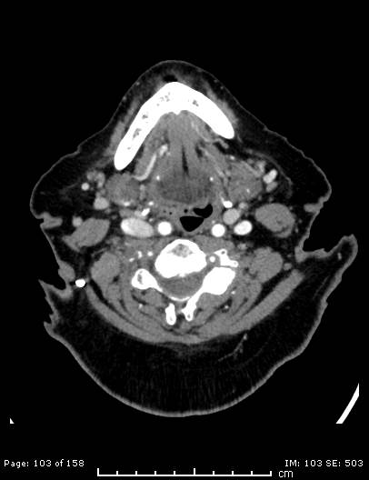 Cerebellar strokes due to intracranial giant cell arteritis (Radiopaedia 68799-78510 CT angiogram 103).jpg