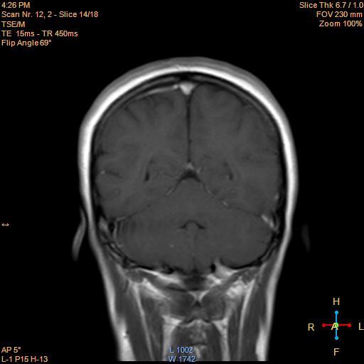 File:Cerebellopontine angle meningioma (Radiopaedia 22488-22525 Coronal T1 C+ 14).jpg