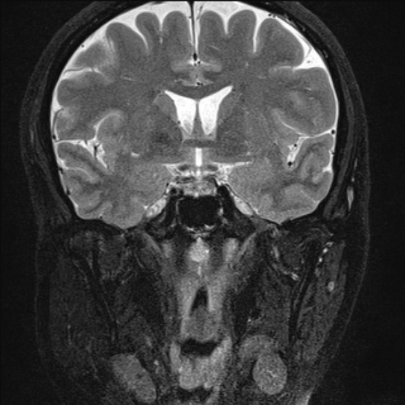File:Cerebellopontine angle meningioma (Radiopaedia 53561-59591 Coronal T2 3).jpg