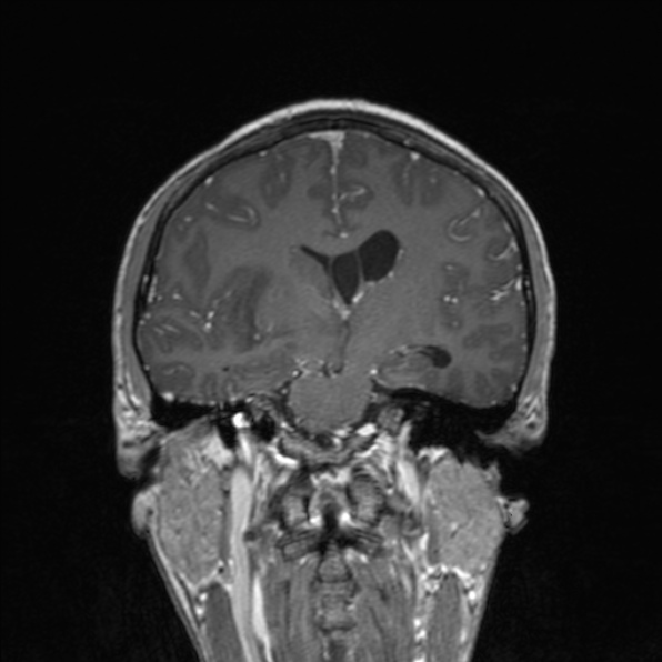 Cerebral abscess (Radiopaedia 24212-24478 Coronal T1 C+ 113).jpg