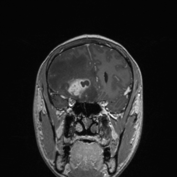 File:Cerebral abscess (Radiopaedia 24212-24478 Coronal T1 C+ 74).jpg
