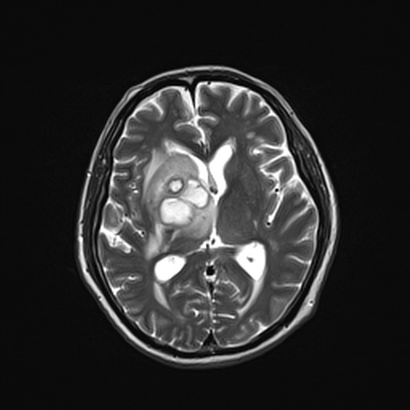 Cerebral abscess (Radiopaedia 26111-26247 Axial T2 34).jpg