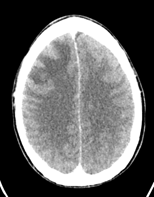 Cerebral abscess (Radiopaedia 60342-68008 Axial C+ delayed 36).png