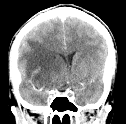 Cerebral abscess (Radiopaedia 60342-68008 Coronal C+ delayed 28).png