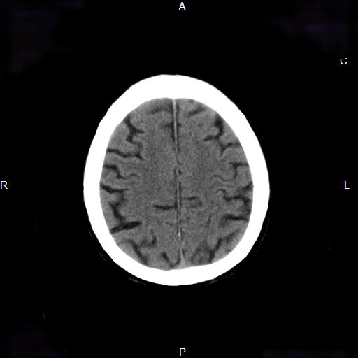 File:Cerebral abscess (Radiopaedia 7606-8431 Axial non-contrast 21).jpg