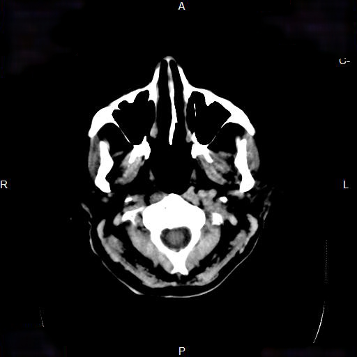 File:Cerebral abscess (Radiopaedia 7606-8431 Axial non-contrast 4).jpg