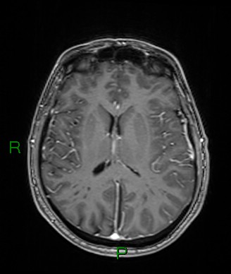 File:Cerebral abscess and subdural empyema (Radiopaedia 84436-99779 Axial T1 C+ 39).jpg