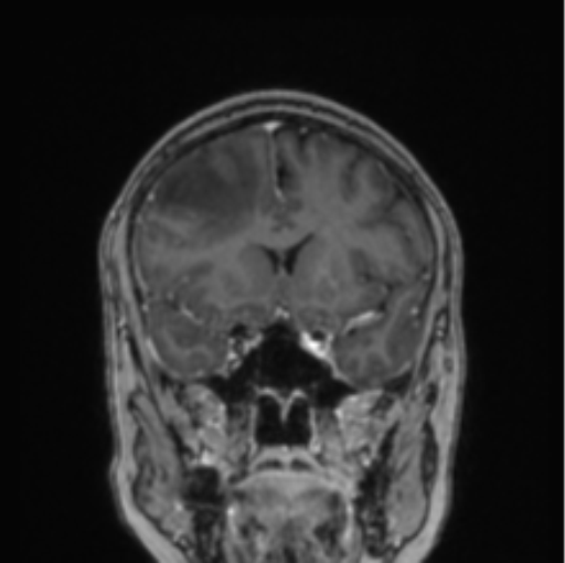 Cerebral abscess from pulmonary arteriovenous malformation (Radiopaedia 86275-102291 L 59).png