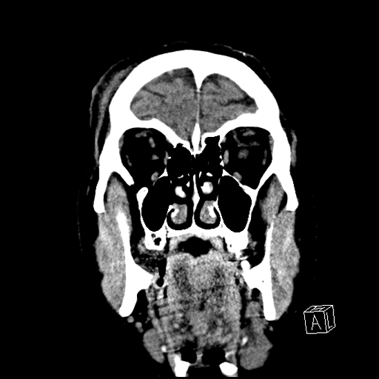 File:Cerebral abscess with ventriculitis (Radiopaedia 78965-91876 B 10).jpg