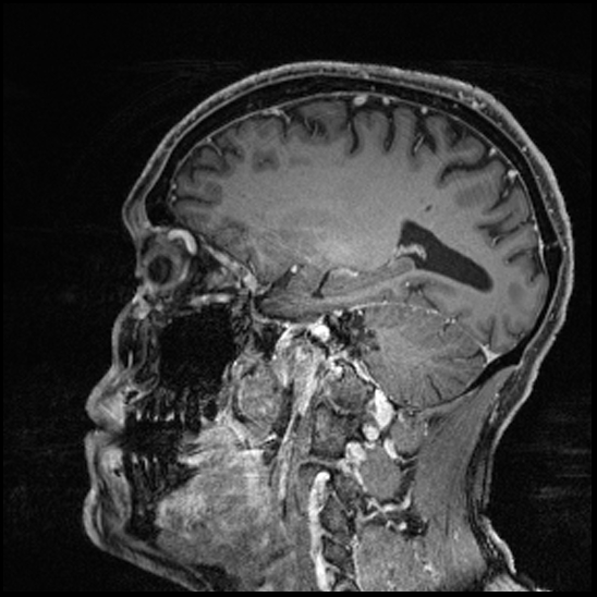 Cerebral abscess with ventriculitis (Radiopaedia 78965-91878 Sagittal T1 C+ 119).jpg