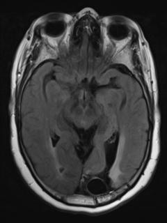 File:Cerebral amyloid angiopathy (Radiopaedia 29129-29518 Axial FLAIR 9).jpg