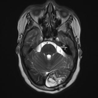 File:Cerebral amyloid angiopathy (Radiopaedia 29129-29518 Axial T2 6).jpg