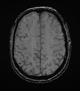Cerebral amyloid angiopathy (Radiopaedia 46082-50433 Axial SWI 60).png
