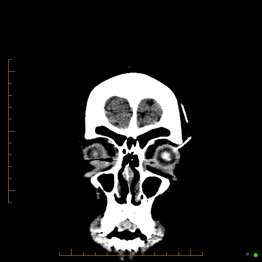 File:Cerebral arteriovenous malformation (AVM) (Radiopaedia 78162-90706 Coronal non-contrast 12).jpg