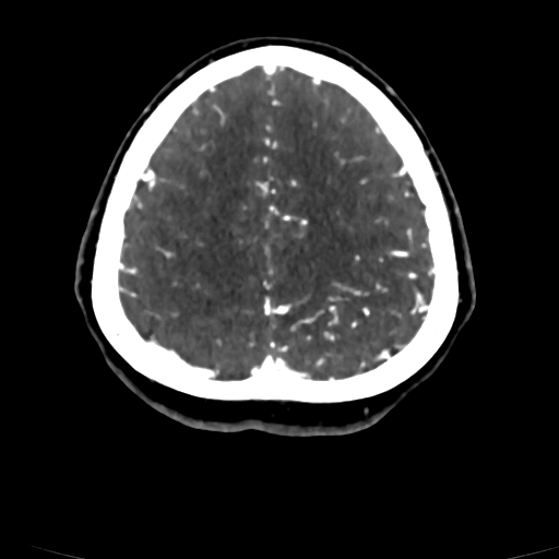 Cerebral arteriovenous malformation (Radiopaedia 73830-84645 Axial C+ delayed 17).jpg