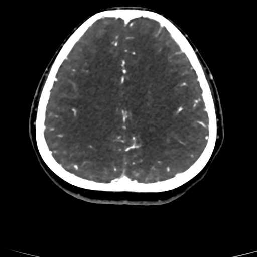 Cerebral arteriovenous malformation (Radiopaedia 73830-84645 Axial C+ delayed 27).jpg