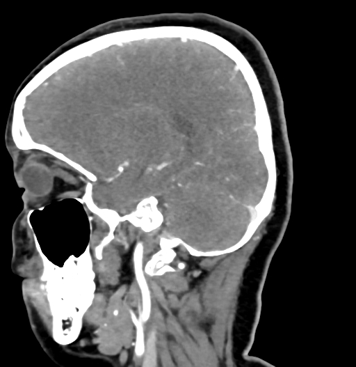 Cerebral arteriovenous malformation (Radiopaedia 73830-84645 D 33).jpg