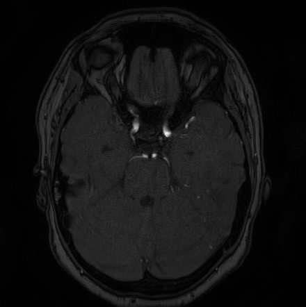 Cerebral arteriovenous malformation (Radiopaedia 74411-85654 Axial MRA 38).jpg