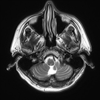 File:Cerebral arteriovenous malformation (Radiopaedia 84015-99245 Axial T2 5).jpg
