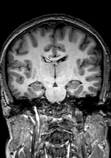 Cerebral arteriovenous malformation at posterior body of corpus callosum (Radiopaedia 74111-84925 Coronal T1 174).jpg