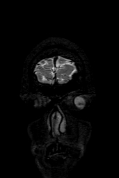 Cerebral arteriovenous malformation at posterior body of corpus callosum (Radiopaedia 74111-84925 Coronal T2 3).jpg