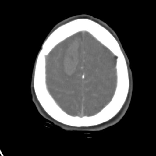 Cerebral arteriovenous malformation with hemorrhage (Radiopaedia 28773-29073 A 11).jpg
