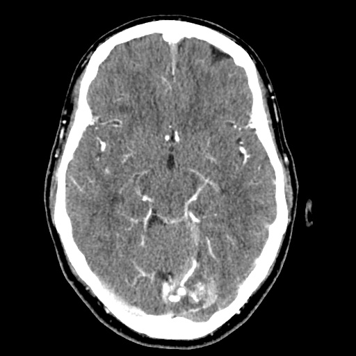 File:Cerebral arteriovenous malformation with lobar hemorrhage (Radiopaedia 35598-57216 A 25).jpg