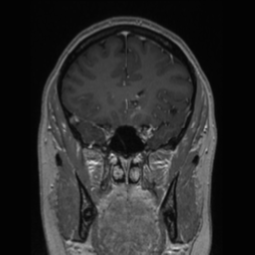 Cerebral cavernoma and development venous anomaly (Radiopaedia 37603-39482 Coronal T1 C+ 65).png
