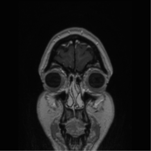 Cerebral cavernoma and development venous anomaly (Radiopaedia 37603-39482 Coronal T1 C+ 86).png