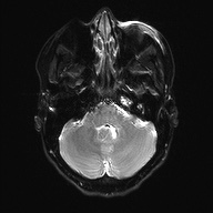 File:Cerebral cavernous venous malformation (Radiopaedia 70008-80021 Axial DWI 7).jpg