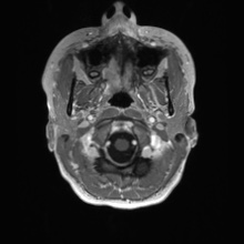 Cerebral cavernous venous malformation (Radiopaedia 70008-80021 Axial T1 C+ 1).jpg