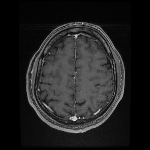 Cerebral cavernous venous malformation (Zabramski type II) (Radiopaedia 85511-101198 Axial T1 C+ fat sat 25).jpg