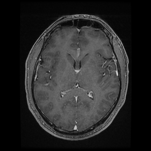 Cerebral cavernous venous malformation (Zabramski type II) (Radiopaedia 85511-101198 Axial T1 C+ fat sat 42).jpg