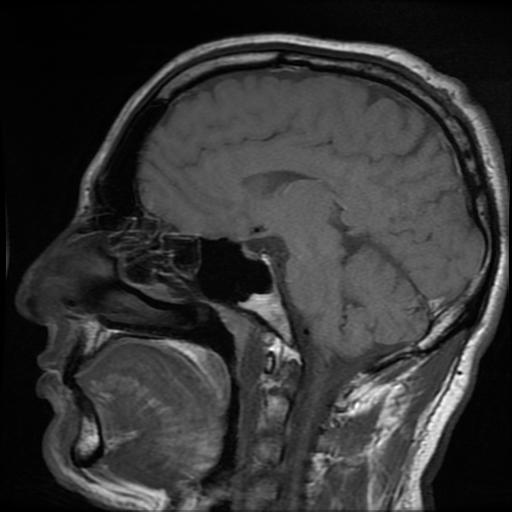 File:Cerebral cavernous venous malformation (Zabramski type II) (Radiopaedia 85511-101198 Sagittal T1 20).jpg