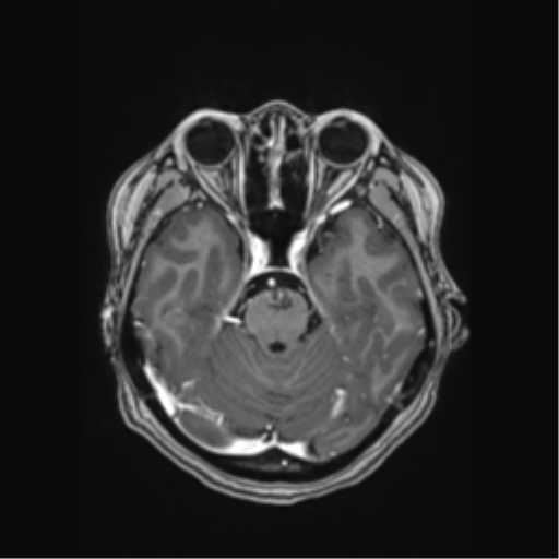 Cerebral cavernous venous malformations (Radiopaedia 48117-52946 Axial T1 C+ 16).png