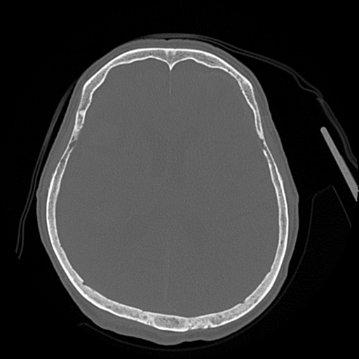 Cerebral contusions, subarachnoid hemorrhage and subdural hygromas (Radiopaedia 55399-61827 Axial bone window 30).png