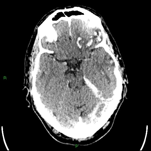 Cerebral contusions (Radiopaedia 33868-35039 Axial non-contrast 73).jpg