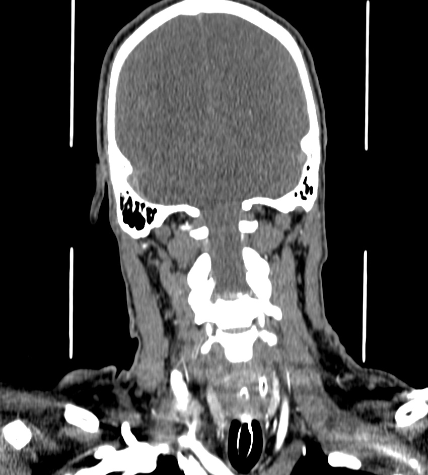 Cerebral edema in an overdose patient (Radiopaedia 72005-82539 B 114).jpg