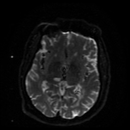 Cerebral embolic infarcts (embolic shower) (Radiopaedia 49837-55108 Axial DWI 25).jpg