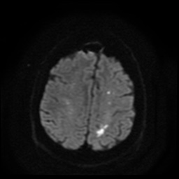 Cerebral embolic infarcts (embolic shower) (Radiopaedia 49837-55108 Axial DWI 61).jpg