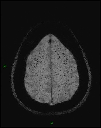 Cerebral fat embolism (Radiopaedia 35022-36525 Axial SWI 49).jpg