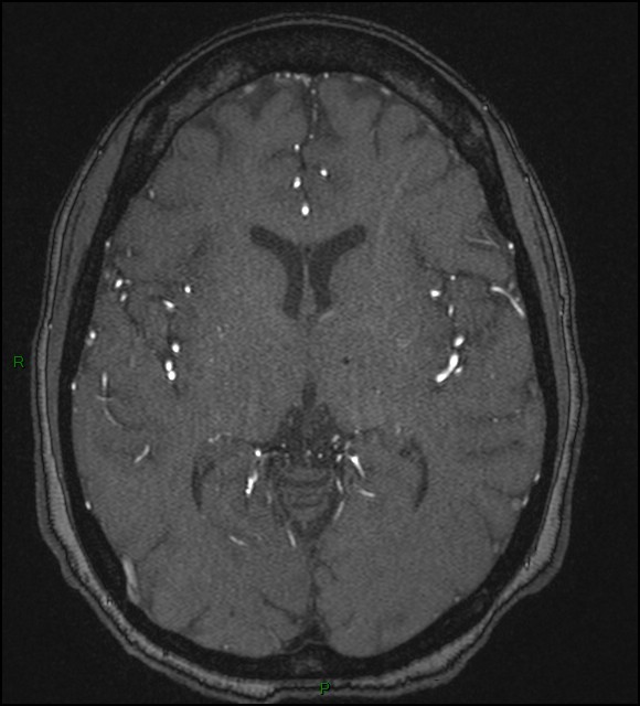 Cerebral fat embolism (Radiopaedia 35022-36525 Axial TOF 106).jpg