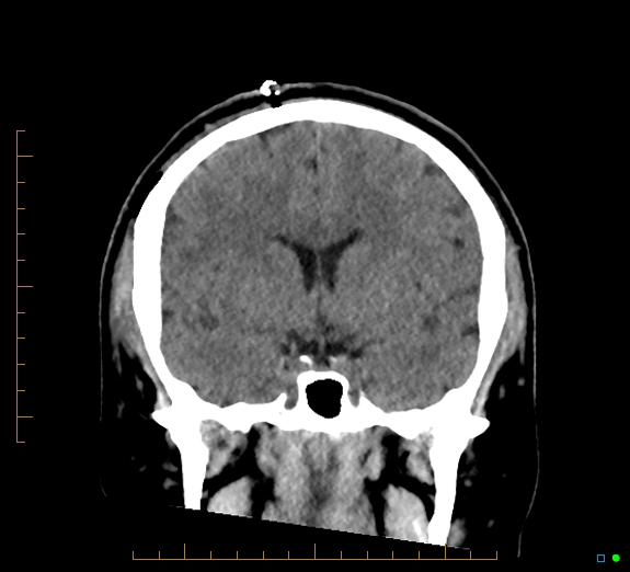 Cerebral fat embolism (Radiopaedia 85521-101224 Coronal non-contrast 28).jpg
