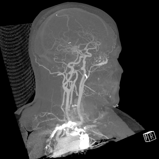 File:Cerebral hemorrhage secondary to arteriovenous malformation (Radiopaedia 33497-34571 A 32).png