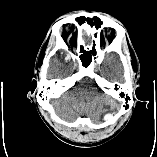 File:Cerebral hemorrhagic contusions- temporal evolution (Radiopaedia 40224-42754 Axial non-contrast 5).png