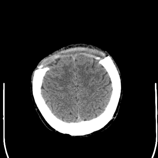 File:Cerebral hemorrhagic contusions- temporal evolution (Radiopaedia 40224-42756 Axial non-contrast 23).png