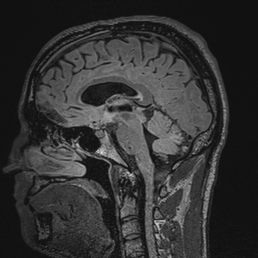 File:Cerebral hemorrhagic contusions- temporal evolution (Radiopaedia 40224-42757 Sagittal T1 39).png