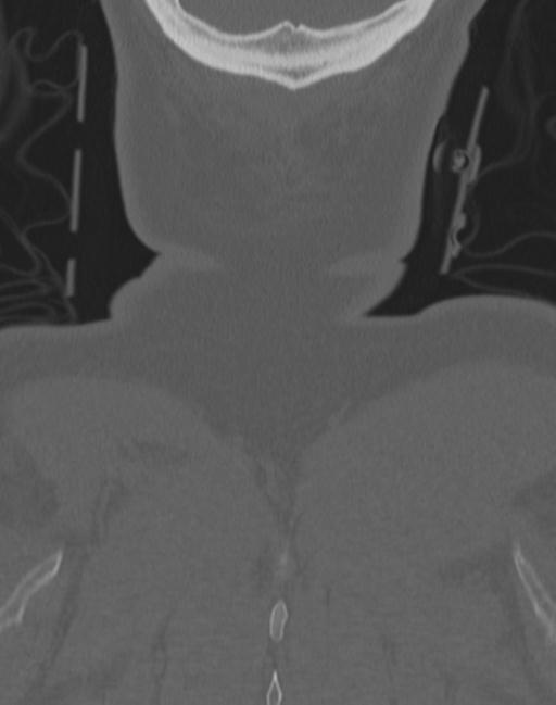 Cerebral hemorrhagic contusions and cervical spine fractures (Radiopaedia 32865-33841 Coronal bone window 81).jpg